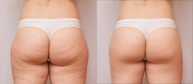 Fat woman before and after. Back loss cellulite. Liposuction female leg concept. Butt shape ass massage