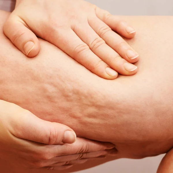 Selülit bacaklı kadın çimdikliyor. Yağ kalçası tedavisini test et. Kilo liposuction yüzünden. Çizgileri sil