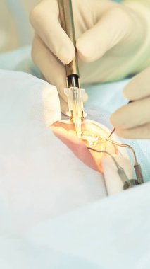 Oftalmoloji lazer mikroskop operasyonu. Klinikte doktor. Hasta göz tedavisi. Miyopi ve katarakt giderme