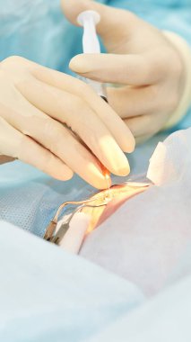 Oftalmoloji lazer mikroskop operasyonu. Klinikte doktor. Hasta göz tedavisi. Miyopi ve katarakt giderme