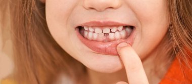 Young girl point on milk tooth. Baby losing teeth