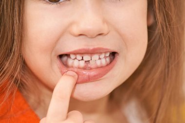 Young girl point on milk tooth. Baby losing teeth