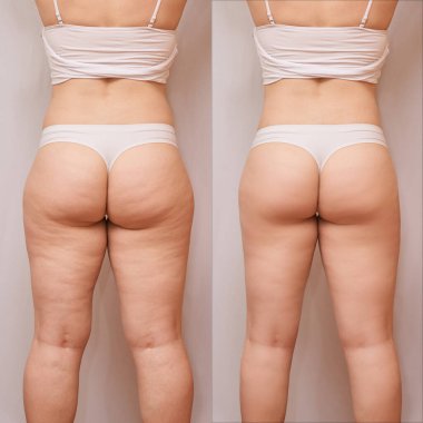 Fat woman before and after. Back loss cellulite. Liposuction female leg concept.