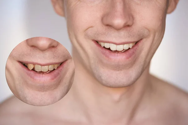 Os homens sorriem. Clareamento conceito de cuidados orais . — Fotografia de Stock