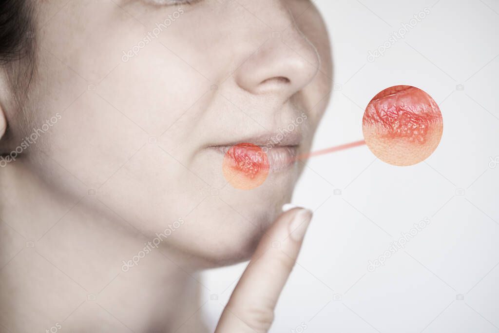 Girl with herpes. Sick symptom. Lips cold