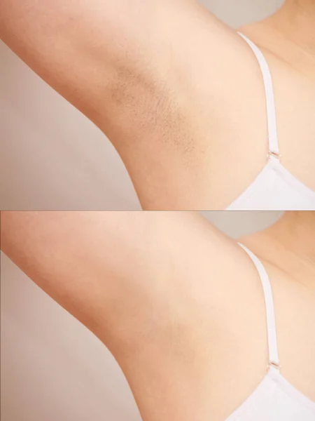 Girl underarm. Before and after hair epilation. — Stock Photo, Image