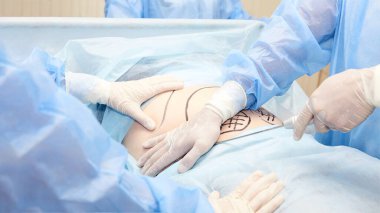 Yağ aldırma operasyonu. Doktor elleri karnına yakın