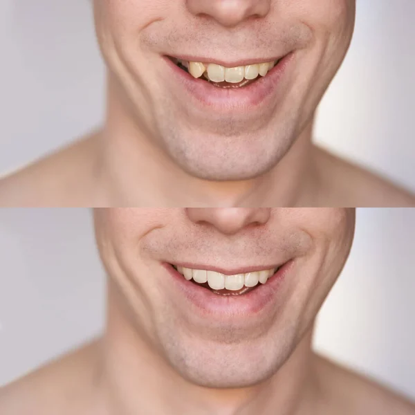 Antes después del concepto de abrazadera. Sonrisa masculina de cerca — Foto de Stock