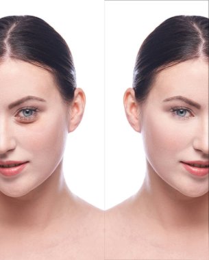 Estetik ameliyattan önce ve sonra kız