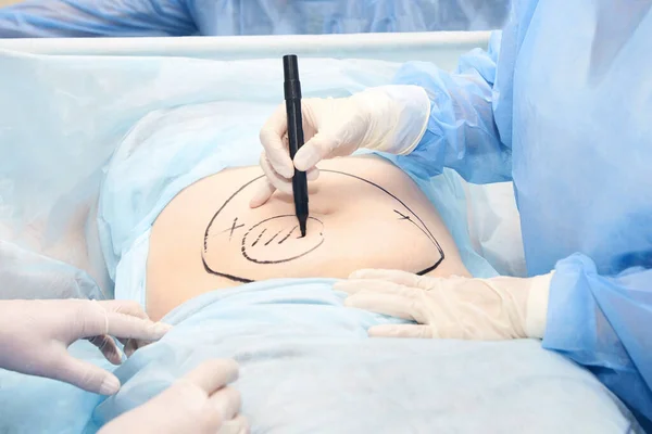 Liposuction operation. Doctor hands near belly — Stock Photo, Image