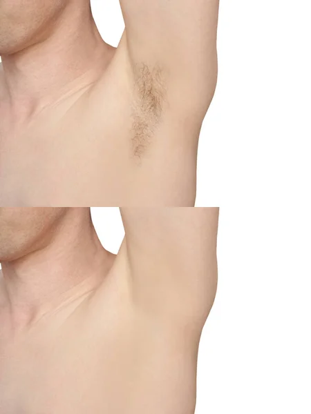 Dziewczyna pod pachą. Pacha białego człowieka. Przed i po depilacji. — Zdjęcie stockowe