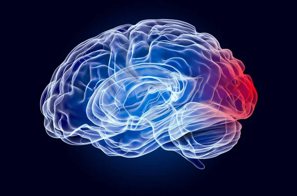 Εγκέφαλος, ασθένεια του ινιακού λοβού έννοια. 3d απόδοση — Φωτογραφία Αρχείου