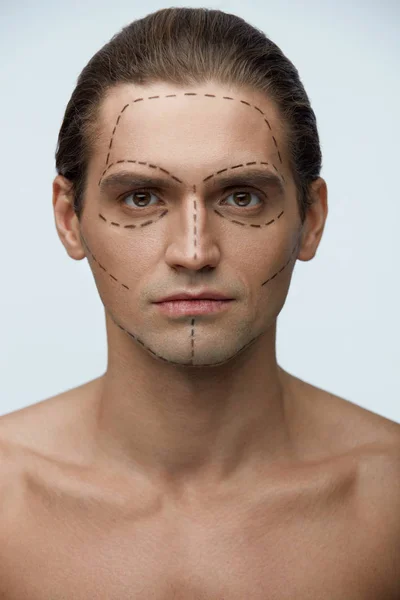 整形手術。顔の皮膚に線がハンサムな男 — ストック写真