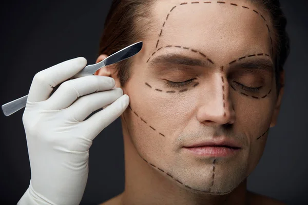 Man met zwarte lijnen op gezicht voordat plastische chirurgie — Stockfoto