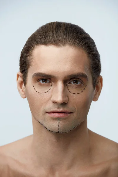 Cirugía plástica. Retrato hombre guapo con líneas en la piel de la cara — Foto de Stock
