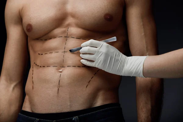 Cirurgia corporal masculina. Close-up do corpo do homem com linhas — Fotografia de Stock