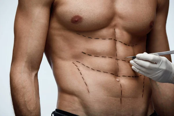 Cirurgia corporal masculina. Close-up do corpo do homem com linhas — Fotografia de Stock