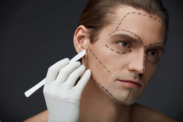 Homem com linhas pretas na cara antes da operação plástica da cirurgia — Fotografia de Stock
