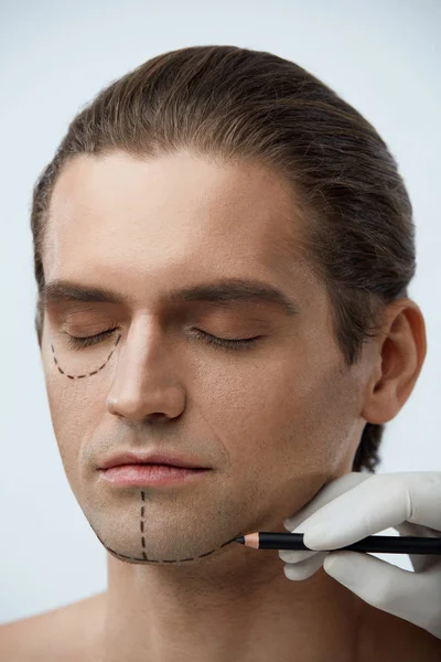 Plasztikai sebészet. Férfi arc arc bőr, fekete vonalakkal — Stock Fotó