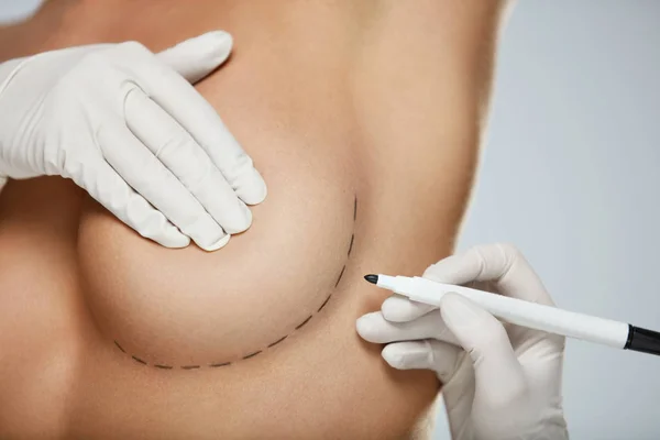 Body Plastic Surgery. Hands Drawing Lines On Woman's Breast.