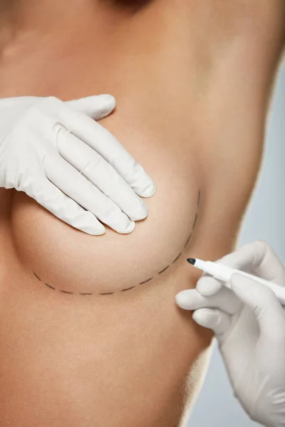 Body Plastic Surgery. Hands Drawing Lines On Woman's Breast.