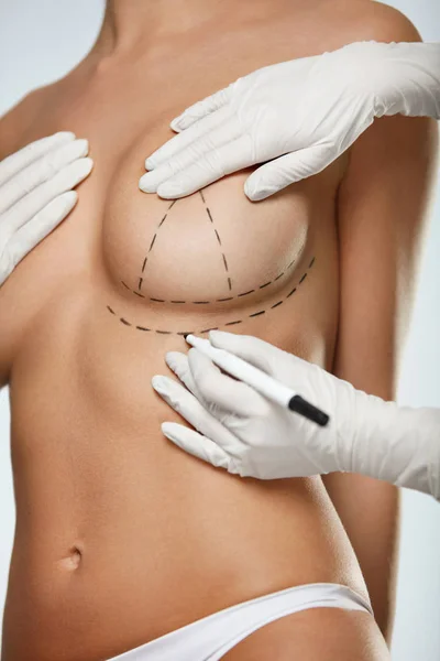 Hände zeichnen Linien auf der schönen Frauenbrust. Plastische Chirurgie — Stockfoto