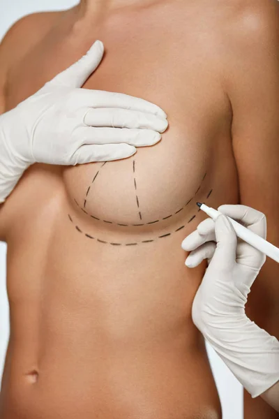 Hände zeichnen Linien auf der schönen Frauenbrust. Plastische Chirurgie — Stockfoto