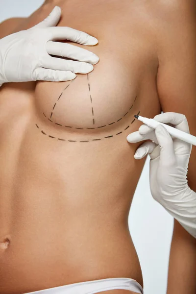 Hände zeichnen Linien auf der schönen Frauenbrust. Plastische Chirurgie — Stockfoto