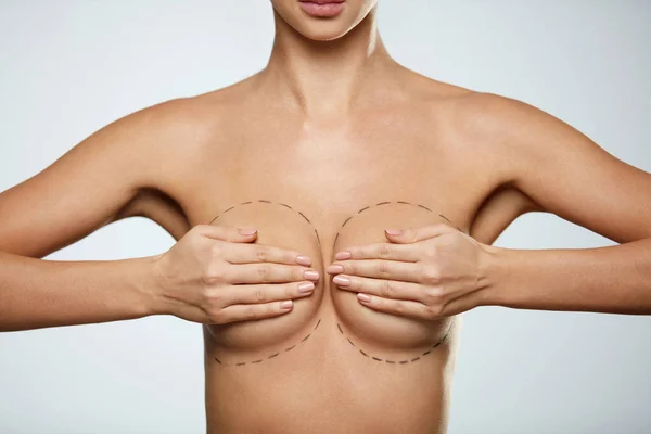 Beauty. Woman Body With Black Lines On Breast. Plastic Surgery — Stock Photo, Image