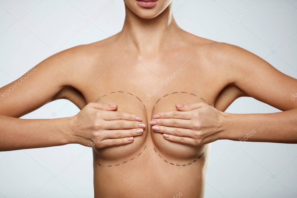 Beauty. Woman Body With Black Lines On Breast. Plastic Surgery