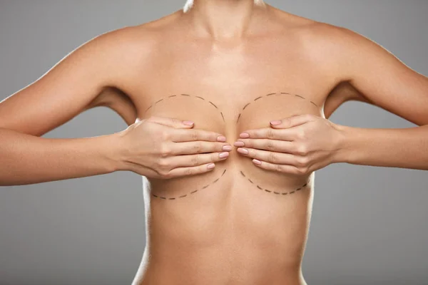 Beleza. Corpo de mulher com linhas pretas no peito. Cirurgia Plástica — Fotografia de Stock