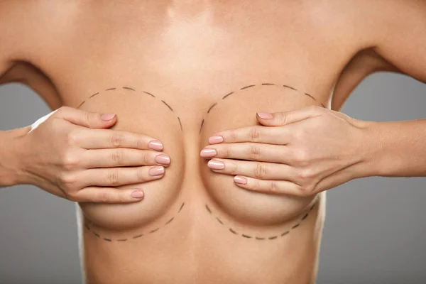 Schoonheid. Het lichaam van de vrouw met zwarte lijnen op borst. Plastische chirurgie — Stockfoto