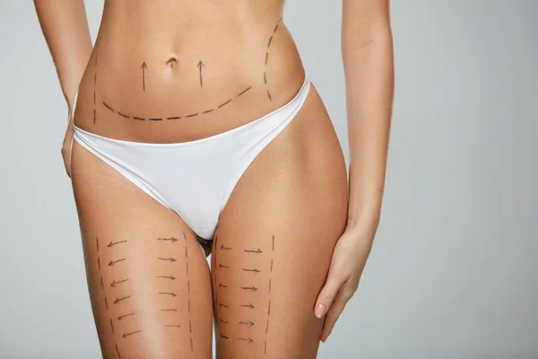 Linhas Cirúrgicas. Corpo de mulher em roupa interior branca com marcas na pele — Fotografia de Stock