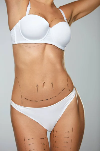 Bellissimo corpo donna con linee chirurgiche. Operazione chirurgica — Foto Stock