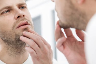 Genç adam onun dudağında herpes acı