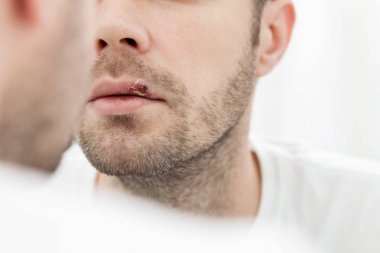 Genç adam onun dudağında herpes acı