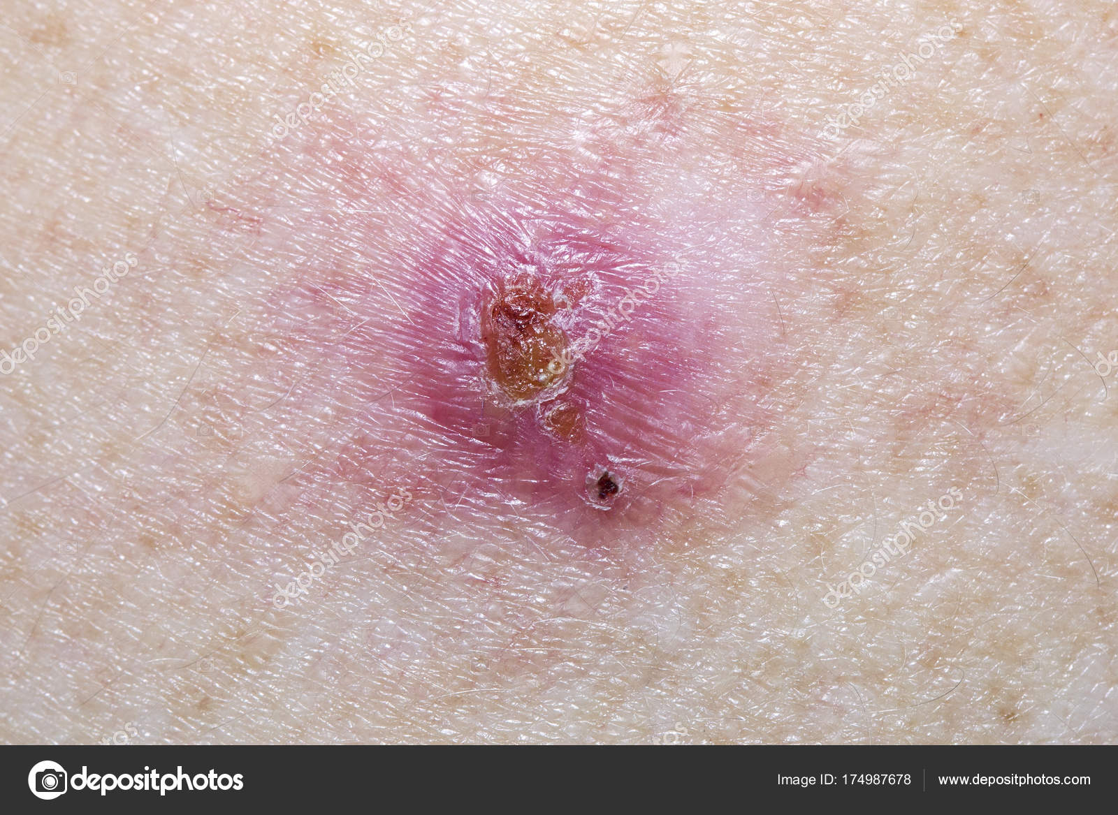 Basal Cell Carcinoma Pre Operative — Stock Photo © jax10289 174987678