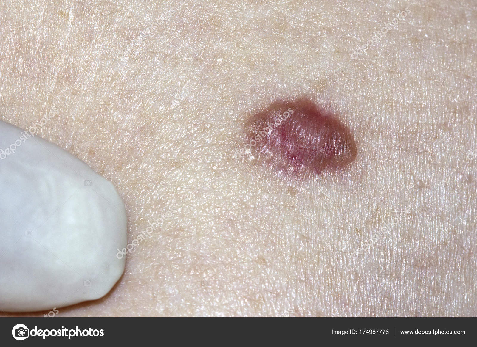 Basal Cell Carcinoma Being Examined Doctor Stock Photo By ©jax10289