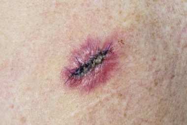 Stitched Incision from the Removal of a Basal Cell Carcinoma which is infected, inflamed and sore.  clipart
