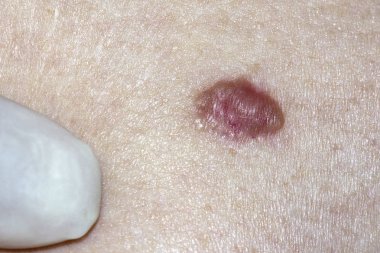 Bazal Hücre Karsinomu bir doktor tarafından muayene ediliyor