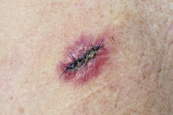 Stitched Incision Removal Basal Cell Carcinoma Yang Terinfeksi Radang Dan — Stok Foto