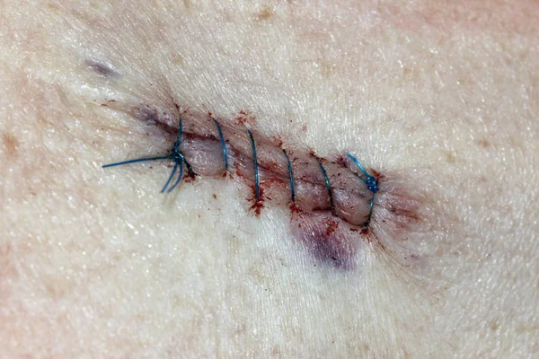 Post Operative Stitches Karsinoma Sel Basal — Stok Foto