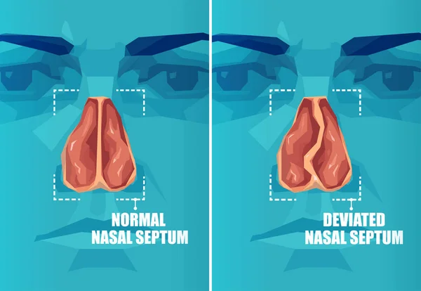 Sección Transversal Vectorial Cara Humana Con Tabique Nasal Desviado Normal — Vector de stock