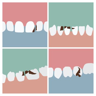 İnsan dişleri çürük - vektör çizimler ile kümesi