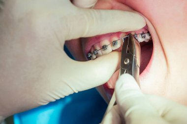 Dişi dişçi resepsiyonda diş teli takılı, ağzı açık. Parlak sistem kappası kapat.