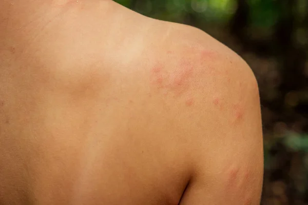 Wanita dengan gatal karena menggigit serangga dalam tubuh di hutan tropis — Stok Foto