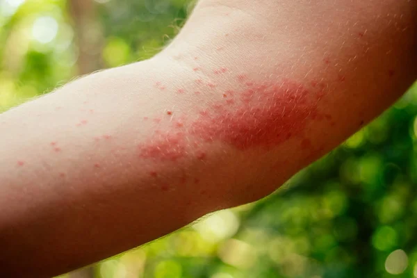 Woman with itching from biting insect in body in tropical jungle forest
