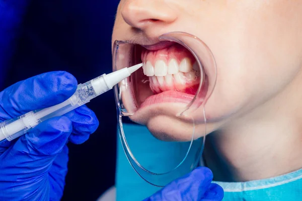 Hermosa pelirroja pelirroja con la boca abierta y boquilla en el dentista con bandeja de blanqueamiento de plástico — Foto de Stock