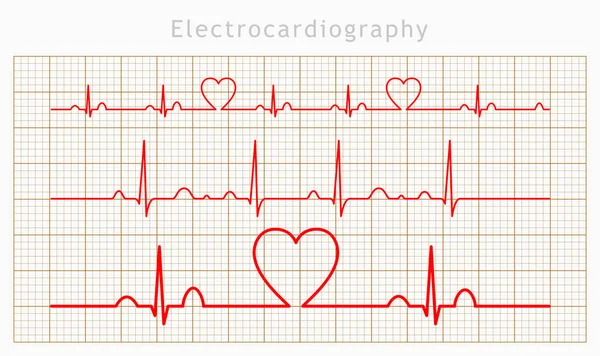Conjunto de gráficos de cardiograma cardíaco vectorial — Archivo Imágenes Vectoriales