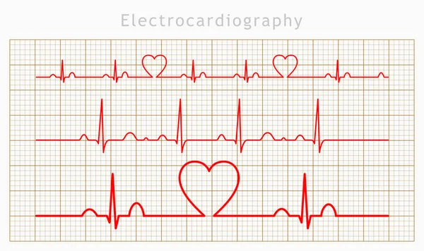 ベクトル心心電図チャート セット — ストックベクタ